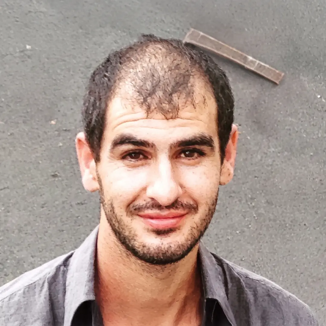Before the hair transplant