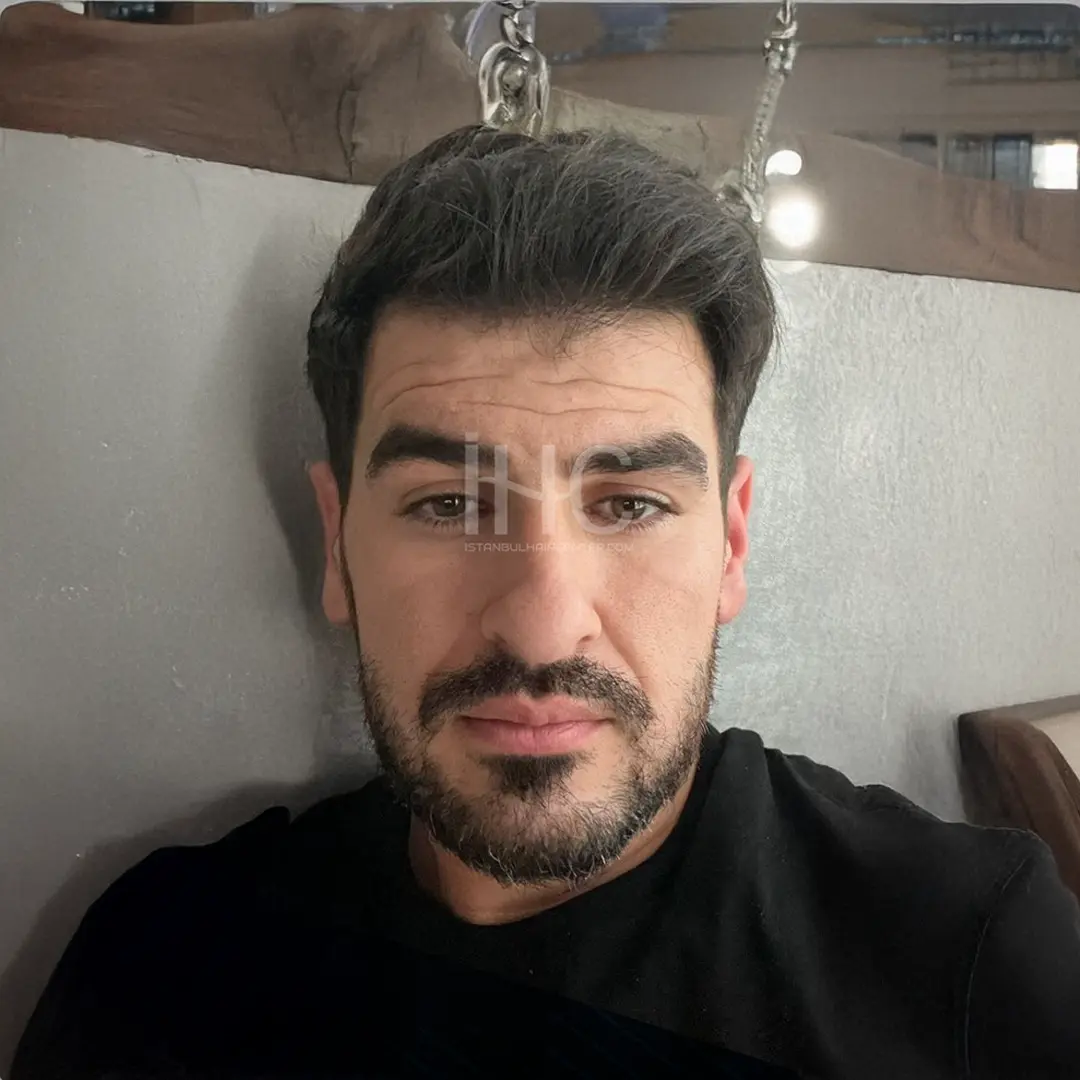 Twelve months after the hair transplant