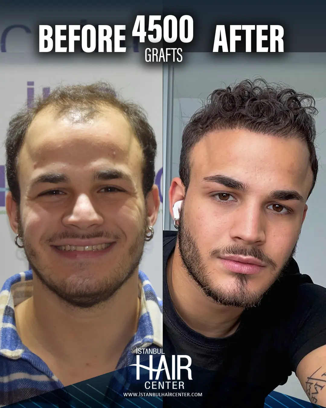 Vito before and after his hair transplant, 4,500 grafts with Sapphire FUE
