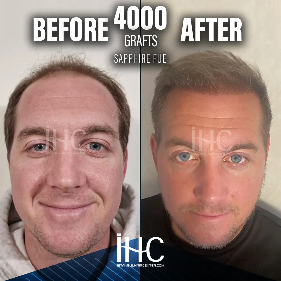 Hair transplant result, before and after