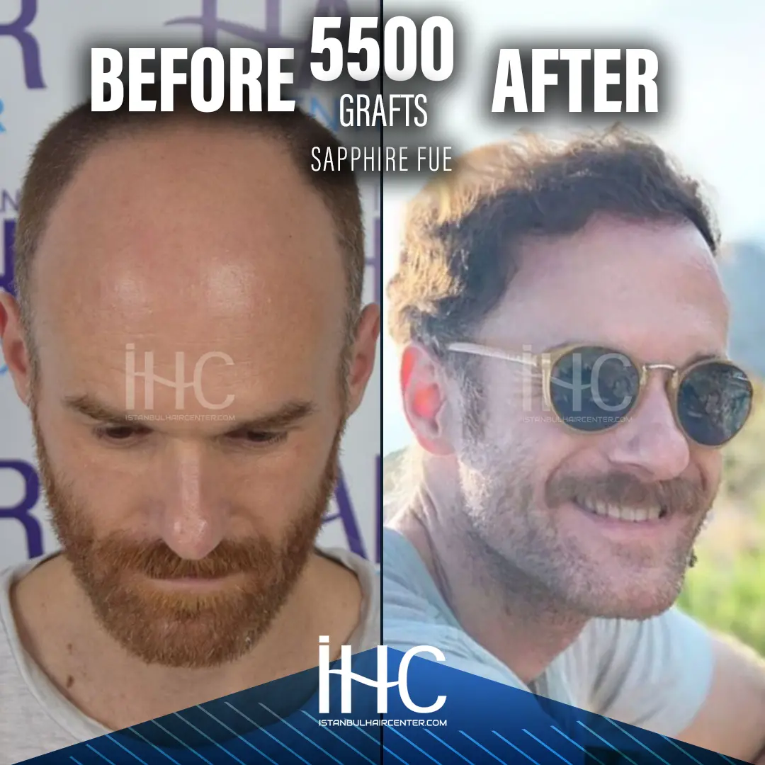 Hair transplant result, before and after