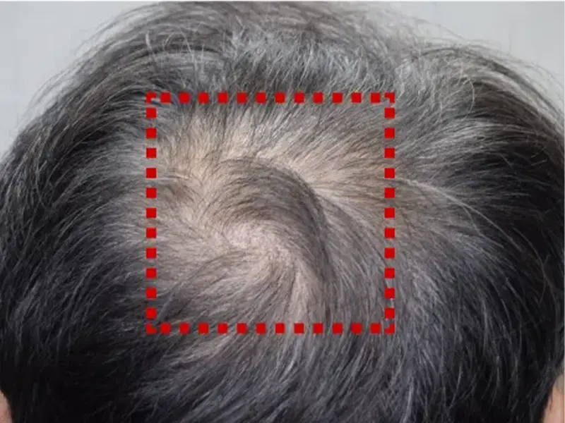 Thinning hair at the crown area